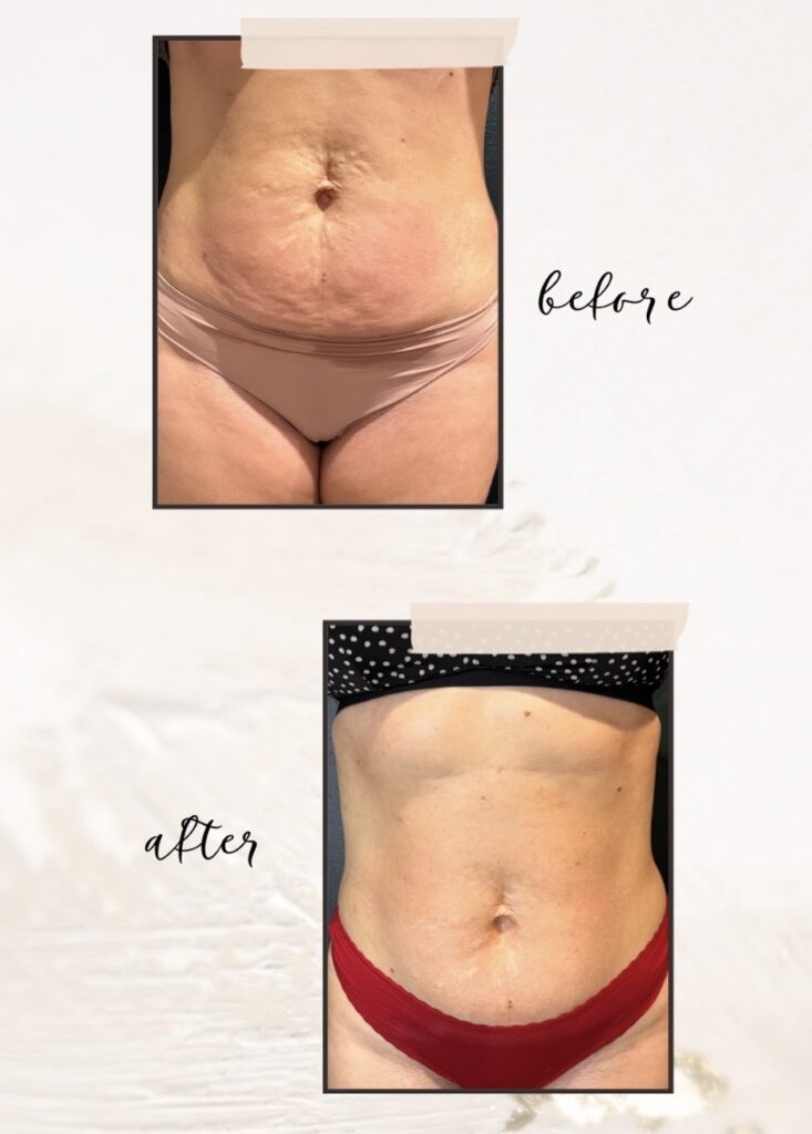 Before & After Results of Instasculpting on Tummy