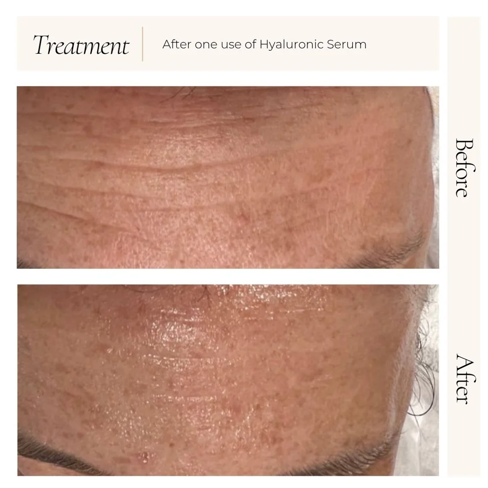 Hyaluronic_before_after